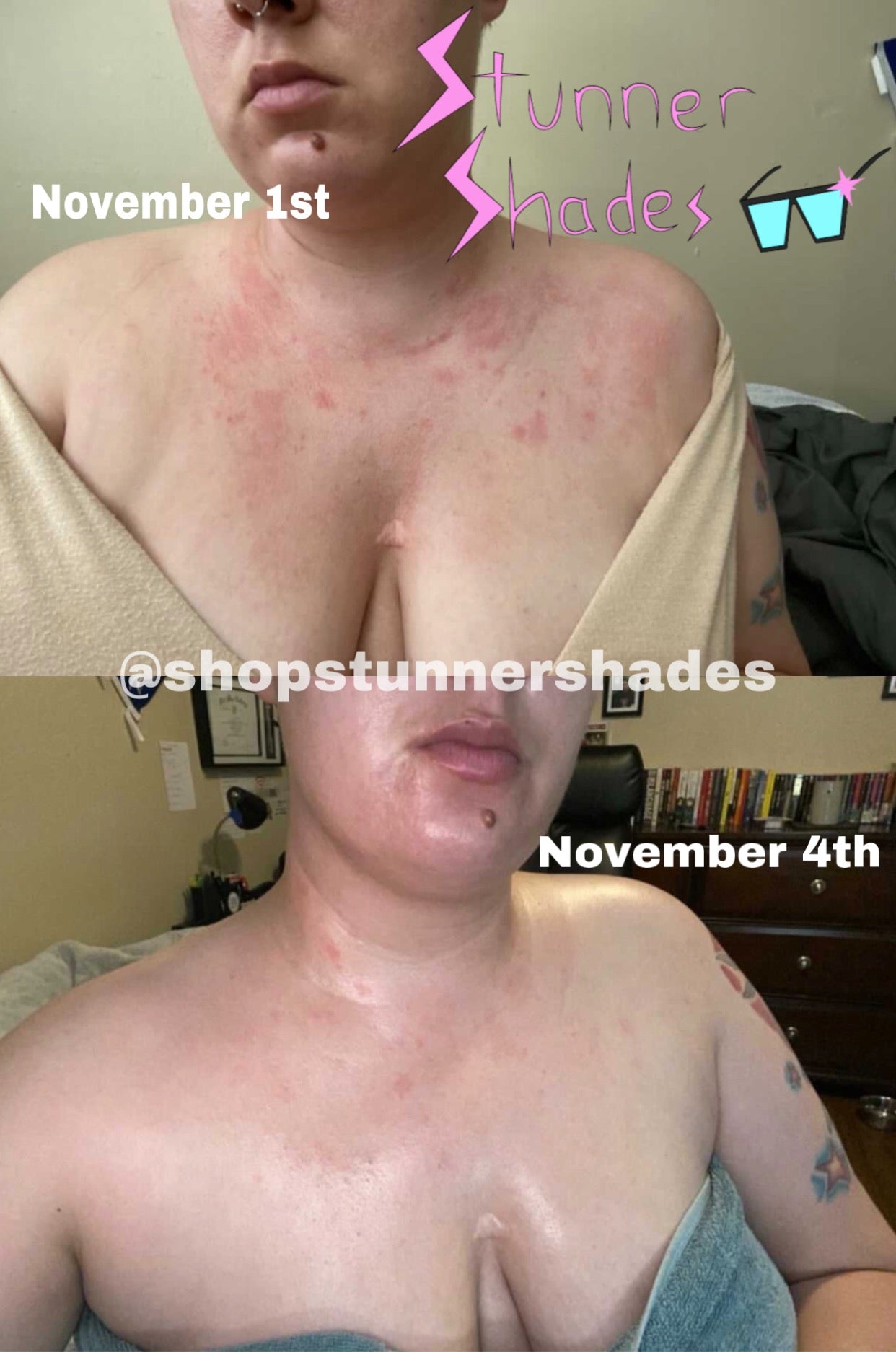Rash After Breast Augmentation