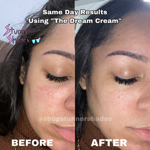 “The Dream Cream” Face & Body Butter (for eczema/psoriasis and acne)
