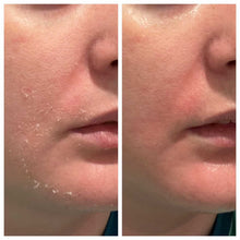 Load image into Gallery viewer, “The Dream Cream” Face &amp; Body Butter (for eczema/psoriasis and acne)
