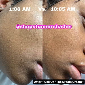 “The Dream Cream” Face & Body Butter (for eczema/psoriasis and acne)